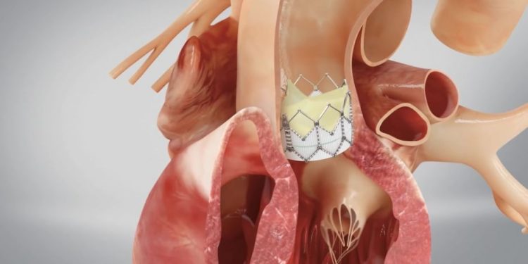 Aortic Valve Symptoms