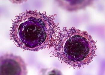 Malignant Mesothelioma Symptoms