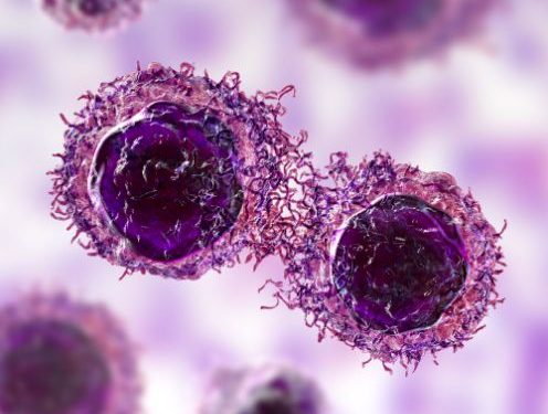 Malignant Mesothelioma Symptoms