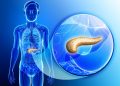 What is the Pancreas Cancer?