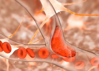 Decompression Sickness