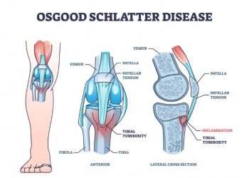 Osgood-Schlatter Disease
