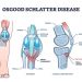 Osgood-Schlatter Disease