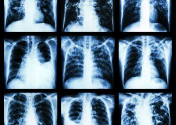 Restrictive Lung Disease Symptoms