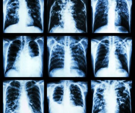 Restrictive Lung Disease Symptoms