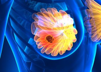 Treatment For Stage 4 Breast Cancer