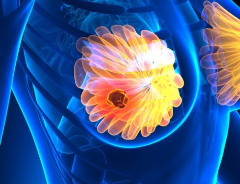 Treatment For Stage 4 Breast Cancer