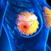 Treatment For Stage 4 Breast Cancer
