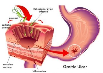 Gastric Ulcer Symptoms and Treatment