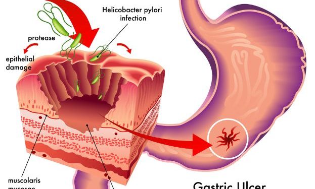 Gastric Ulcer Symptoms and Treatment