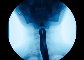 Esophageal Cancer Symptoms