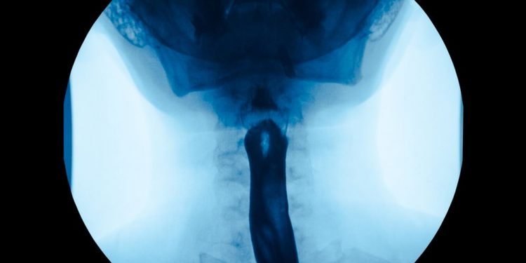 Esophageal Cancer Symptoms