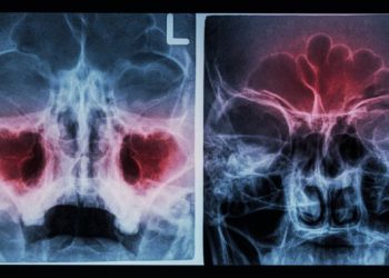 Nasal and Sinus Diseases Symptoms