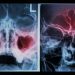 Nasal and Sinus Diseases Symptoms