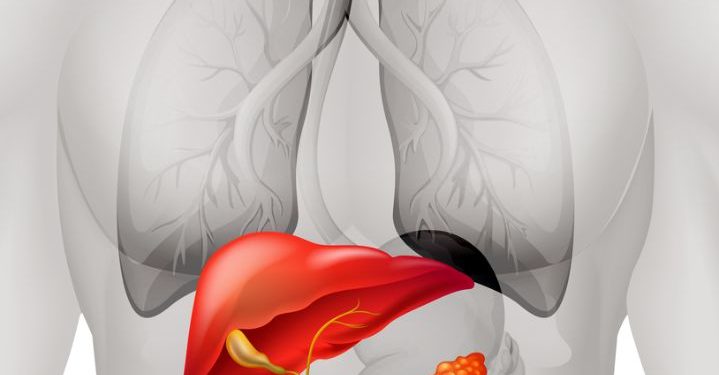 Stage 4 Liver Cancer