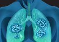Life Expectancy for Stage IV Lung Cancer