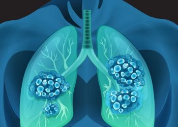 Life Expectancy for Stage IV Lung Cancer