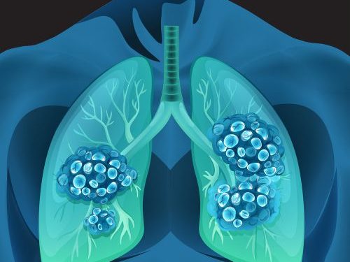 Life Expectancy for Stage IV Lung Cancer