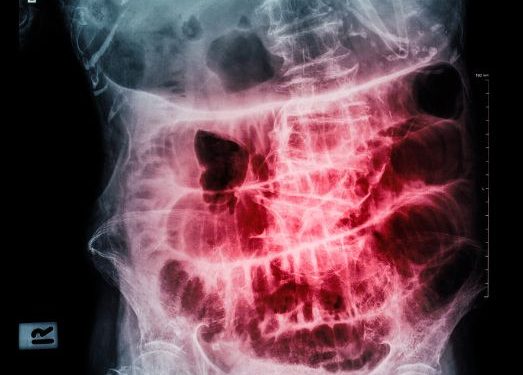 What is Small Bowel Cancer?