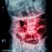 What is Small Bowel Cancer?