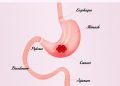 How to Treat a Tumor in the Stomach