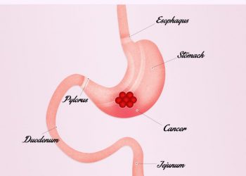 How to Treat a Tumor in the Stomach