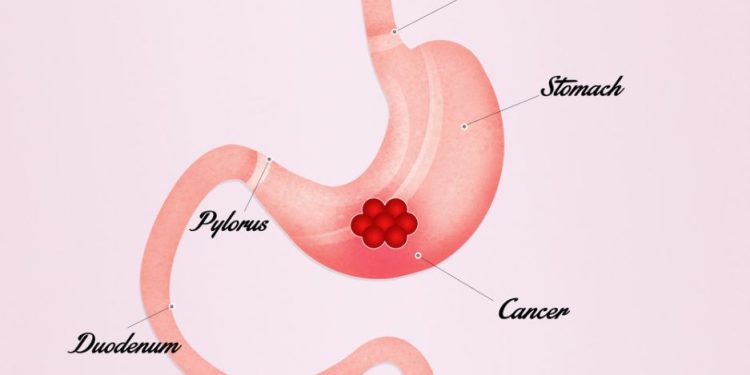 How to Treat a Tumor in the Stomach