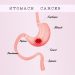 How to Treat a Tumor in the Stomach