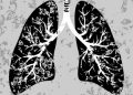 Stage 4 Lung Cancer Symptoms of Dying