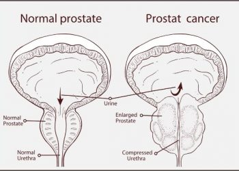 How Do Normal PSA Levels Affect a Man’s Prostate?