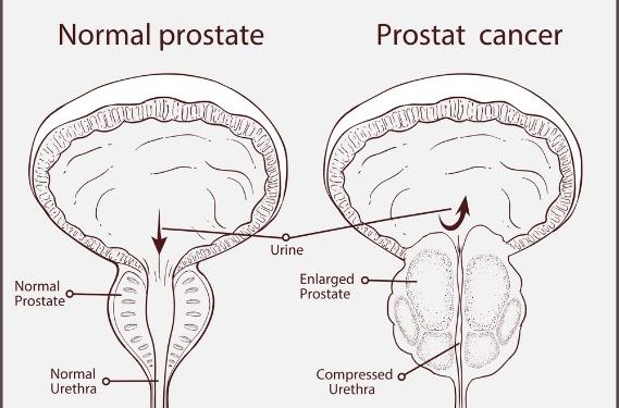 How Do Normal PSA Levels Affect a Man’s Prostate?