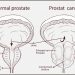 How Do Normal PSA Levels Affect a Man’s Prostate?