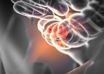 What is Stage 3 Breast Cancer?