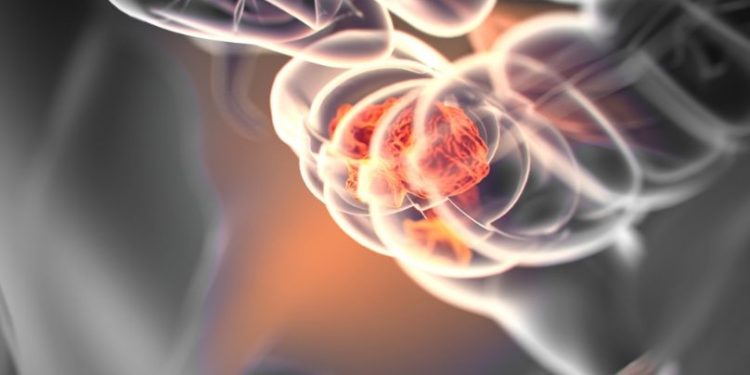 What is Stage 3 Breast Cancer?