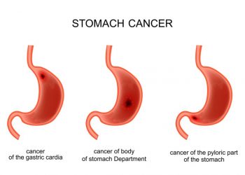 Gastric Adenocarcinoma – Prognosis and Treatment