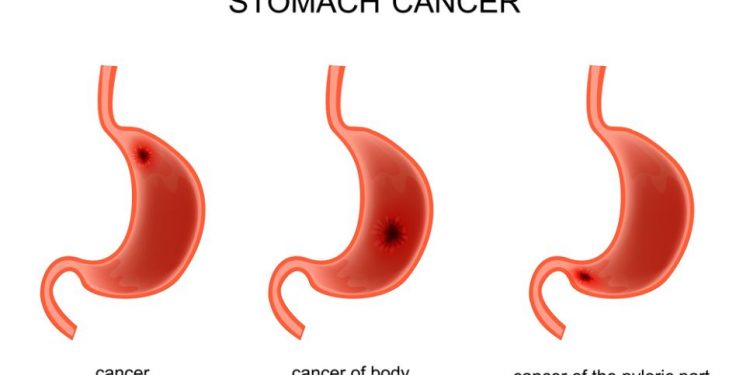 Gastric Adenocarcinoma – Prognosis and Treatment