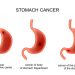 Gastric Adenocarcinoma – Prognosis and Treatment