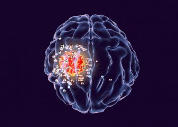 Stage 4 Brain Cancer Timeline