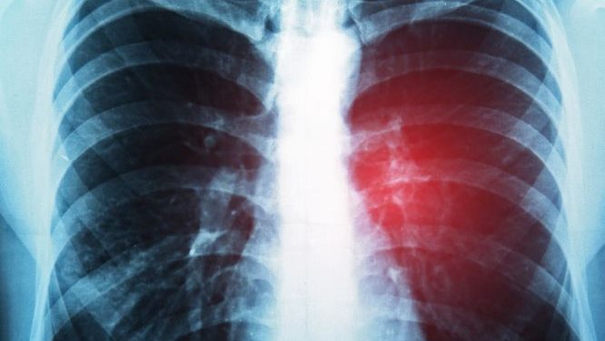 Adenocarcinoma Lung Cancer