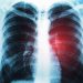 Adenocarcinoma Lung Cancer