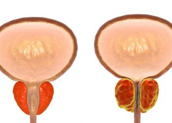 What Treatments Are Available For Prostate Cancer?