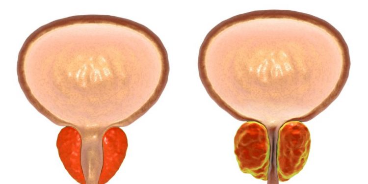 What Treatments Are Available For Prostate Cancer?