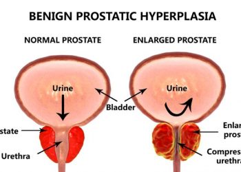 What You Should Know About Prostate Removal