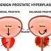 What You Should Know About Prostate Removal