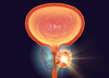 How to Treat a Prostate Infection