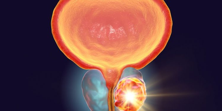 How to Treat a Prostate Infection