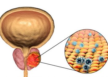 Benign Prostatic Hyperplasia Treatments