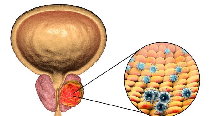 Benign Prostatic Hyperplasia Treatments