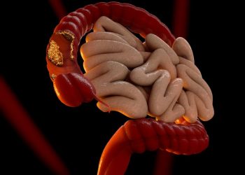 Stage 4 Colon Cancer CEA Level