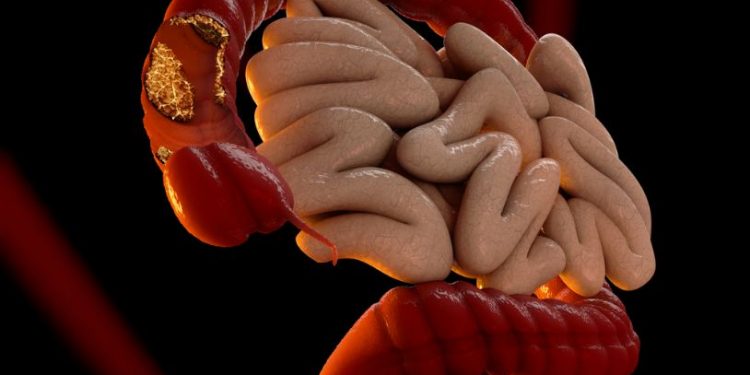 Stage 4 Colon Cancer CEA Level